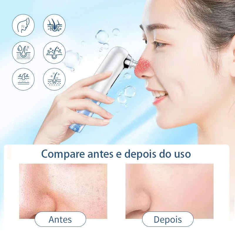 Removedor elétrico de cravos, remoção de espinhas, acne, sucção a vácuo, limpador de poros, limpeza facial